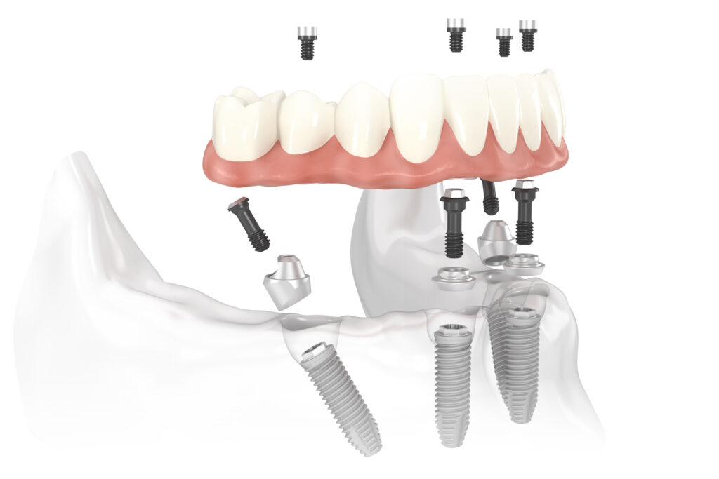 Имплантация All-on-4 — идеальное решение для полной реконструкции зубного ряда